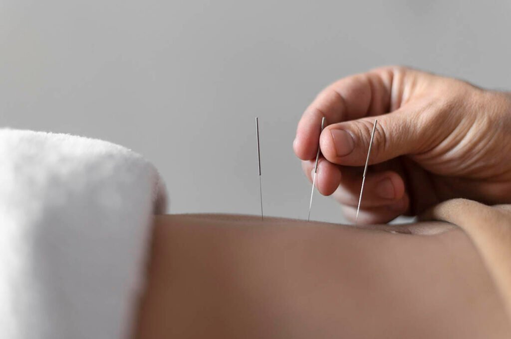 การฝังเข็มแบบตะวันตก close up hand holding acupuncture needle