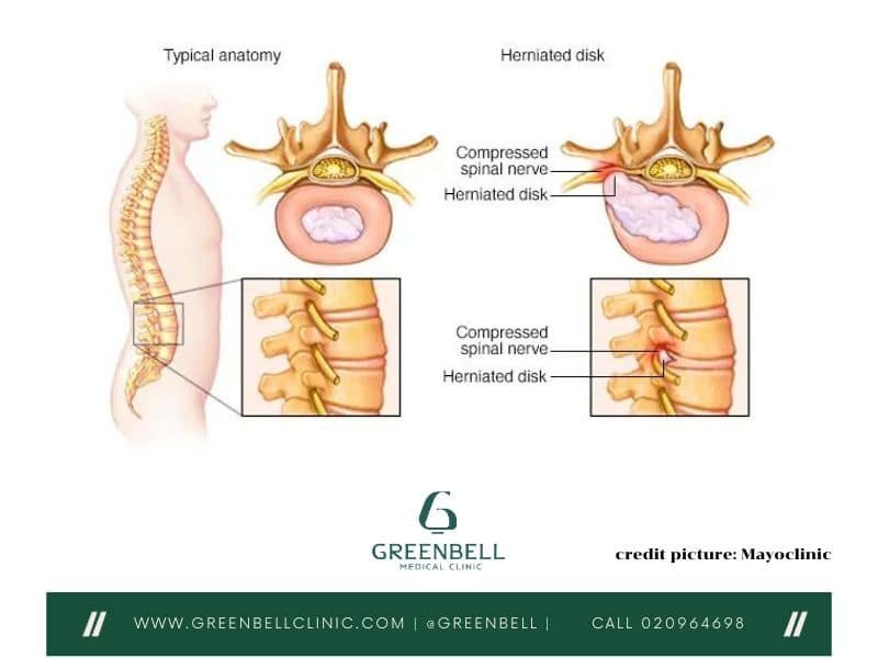 หมอนรองกระดูกทับเส้นประสาท,ปวดหลังส่วนล่าง, Greenbell Clinic