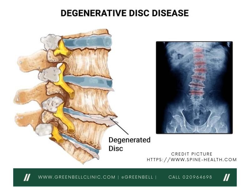 Degenerate Disc Relief, Greenbell Clinic