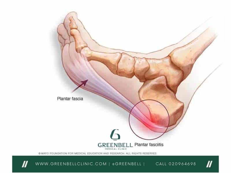 Plantar Fasciitis, Greenbell Clinic