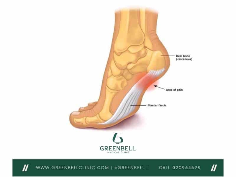 Plantar Fasciitis, Greenbell Clinic