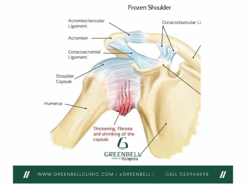 frozen shoulder, Greenbell Clinic