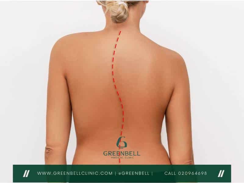 กระดูกสันหลังคด,Scoliosis, Greenbell Clinic