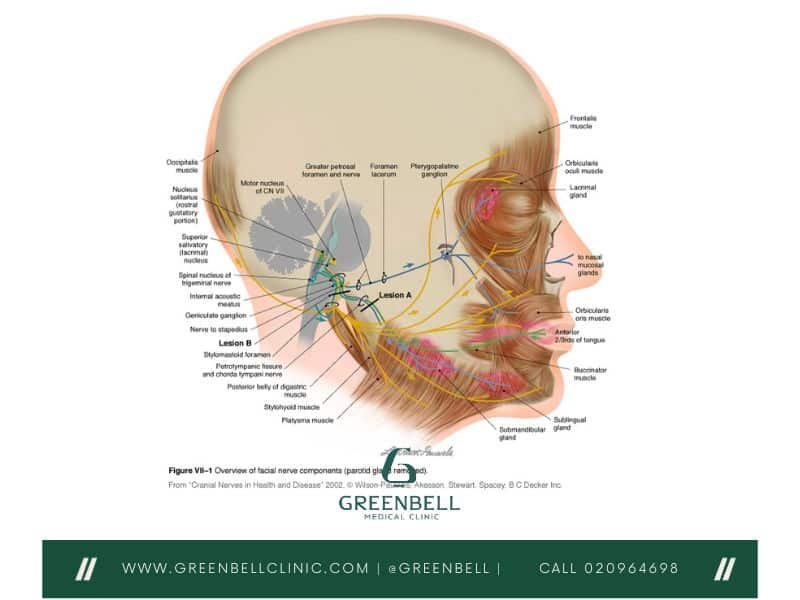 Bell's Palsy,Facial Paralysis, Greenbell Clinic