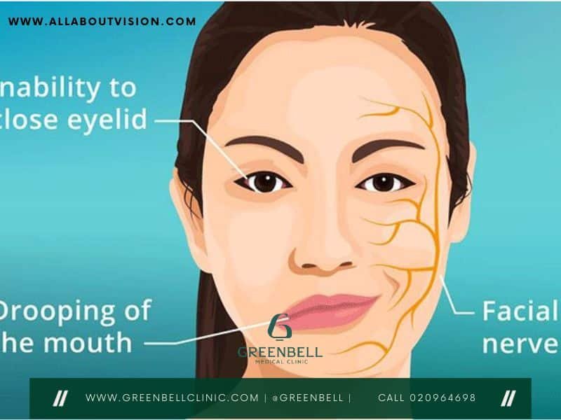 Bell's Palsy,Facial Paralysis, Greenbell Clinic