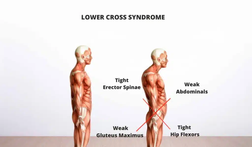 Low crossed Syndrome, Greenbell Clinic