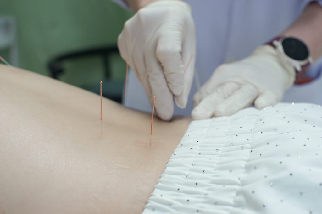 Acupuncture for Allergies