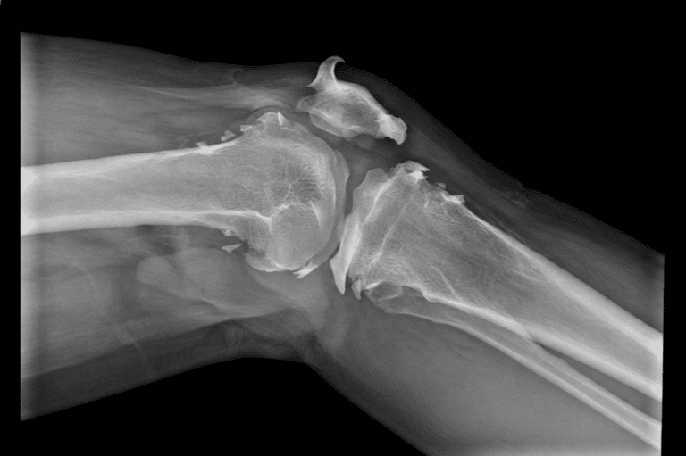 Bone Spurs,What is a bone spur?,Bone spur symptoms