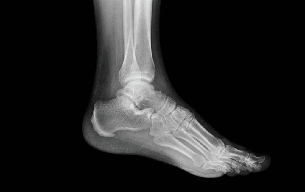 Bone Spur