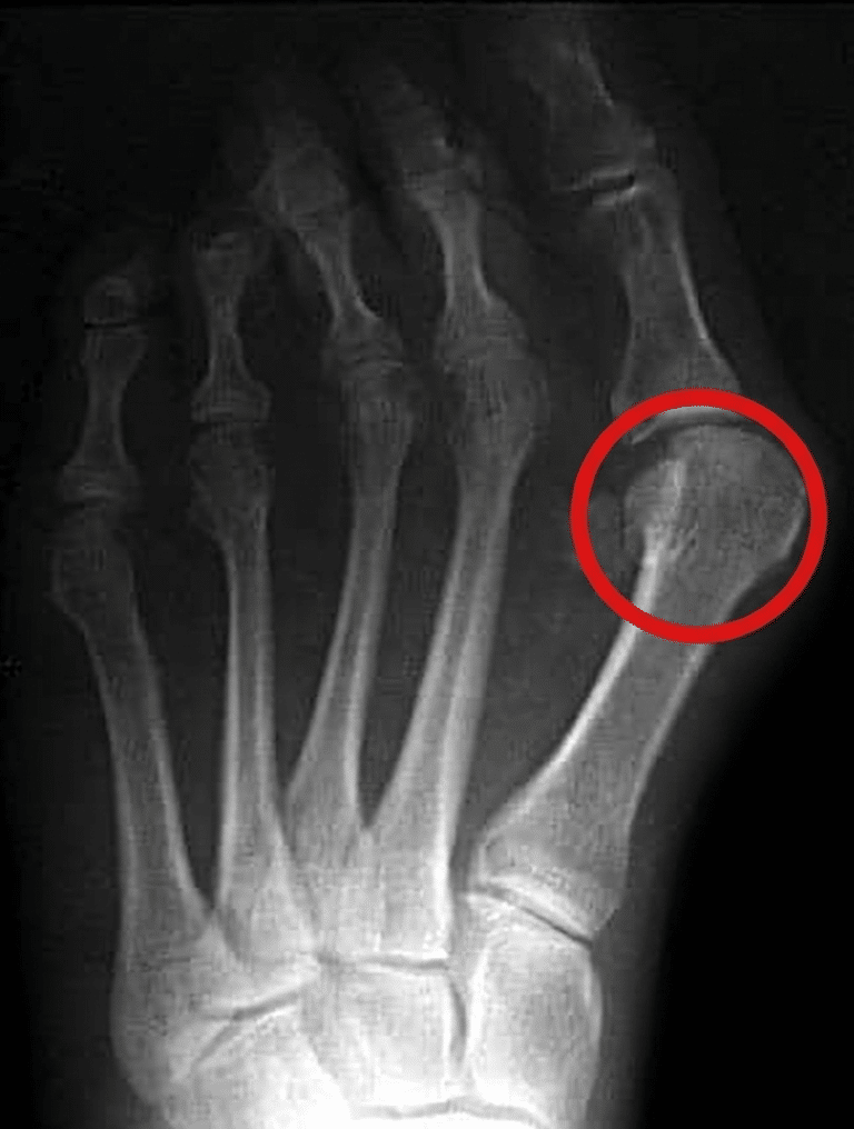Bone Spurs,What is a bone spur?,Bone spur symptoms
