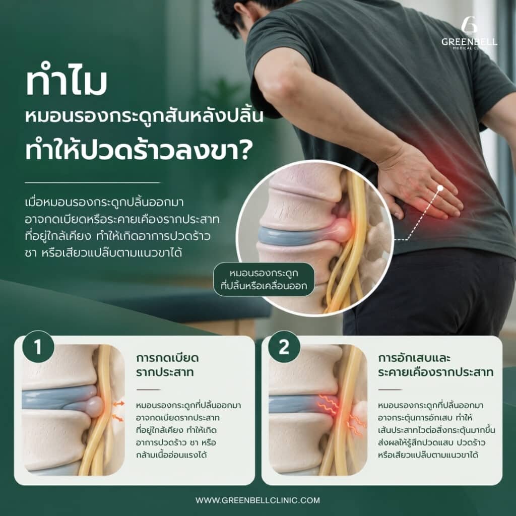 หมอนรองกระดูกปลิ้น