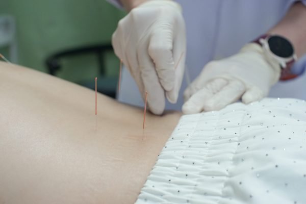 Traditional Chinese Acupuncture